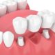 Dental Bridges 101: Understanding the What and How